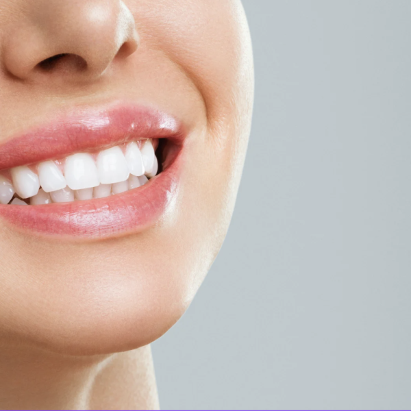 Teeth Whitening